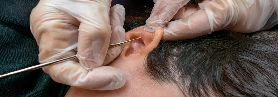 عملية تجميل الأذن في تركيا (دليل 2026): التكلفة، التعافي والنتائج قبل وبعد