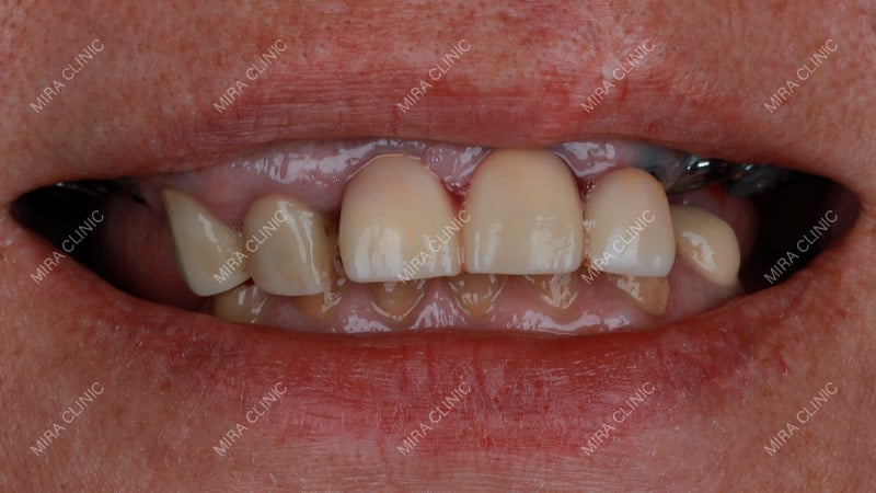 Hollywood Smile in Turkey: All-Inclusive Packages, Prices & Lifetime Warranty (2027)