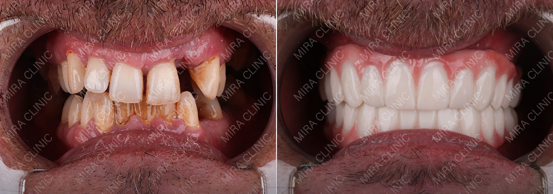 Can Veneers Fix Crooked Teeth? When It Works (and When Braces Are the Better Move)