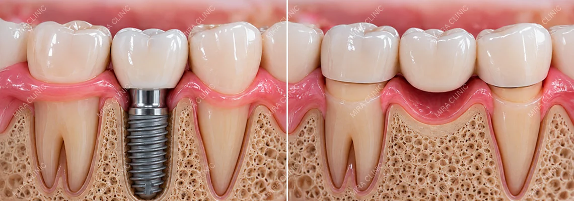 Dental Implant vs Dental Bridge: Which Is Better for a Missing Tooth?