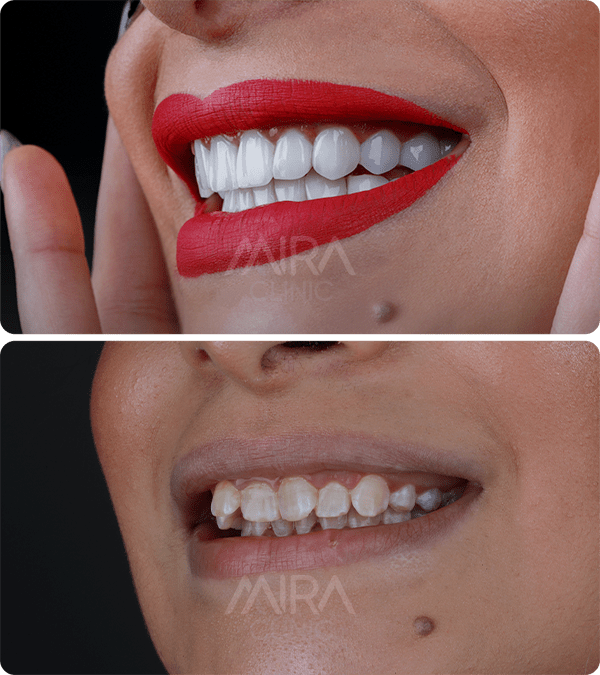 Before & After Hollywood smile 