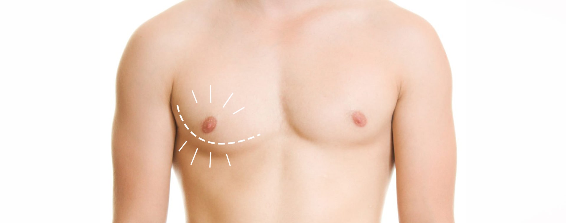 Gynecomastia in turkey