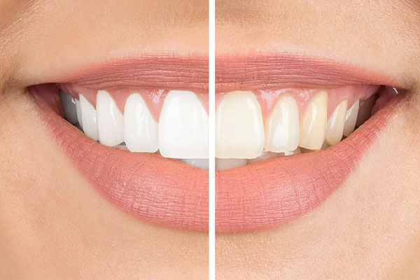 Veneers vs. Dental Bonding
