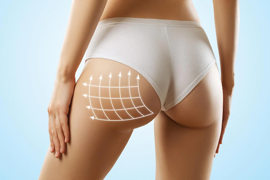 buttock reduction in turkey2023