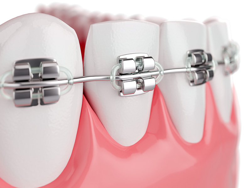  أنواع تقويم الأسنان