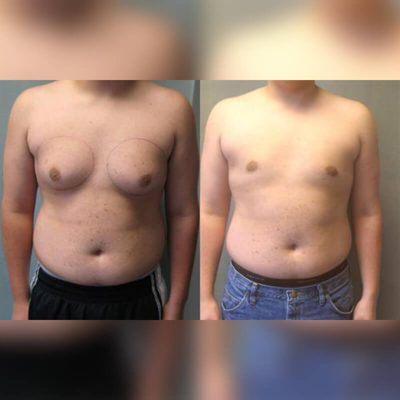 تصغير الثدي عند الرجال بدون جراحة