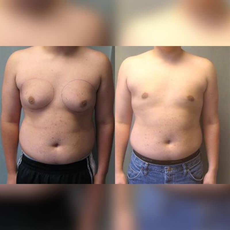 Male breast reduction without surgery