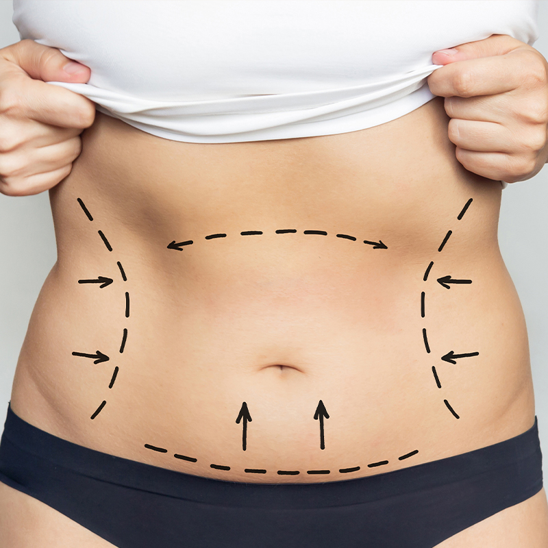 Tummy tuck recovery