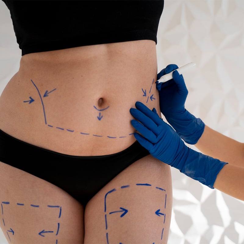 liposuction price in Turkey