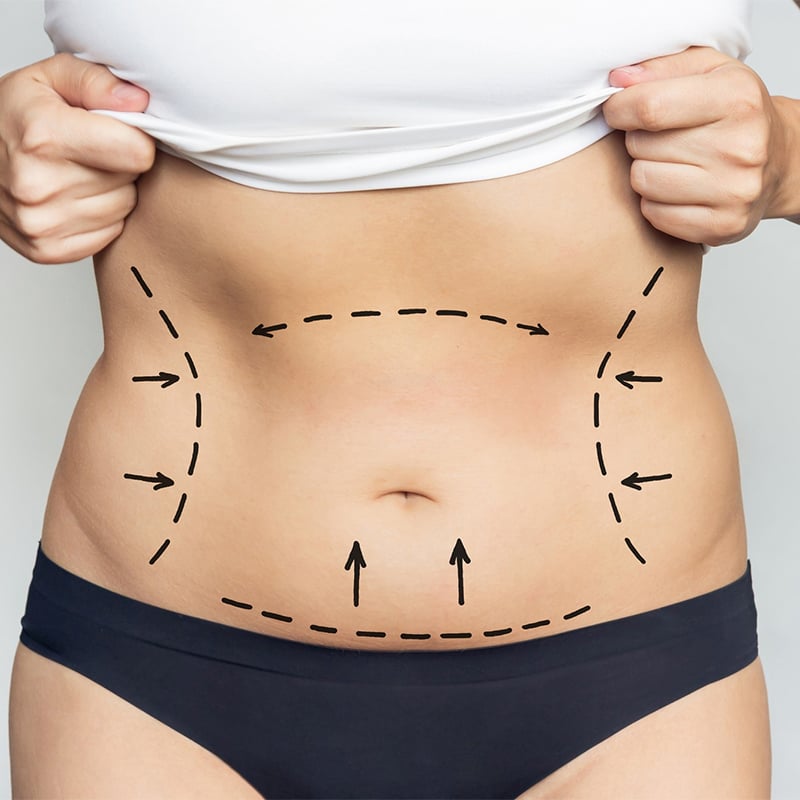 coûte une abdominoplastie en Turquie