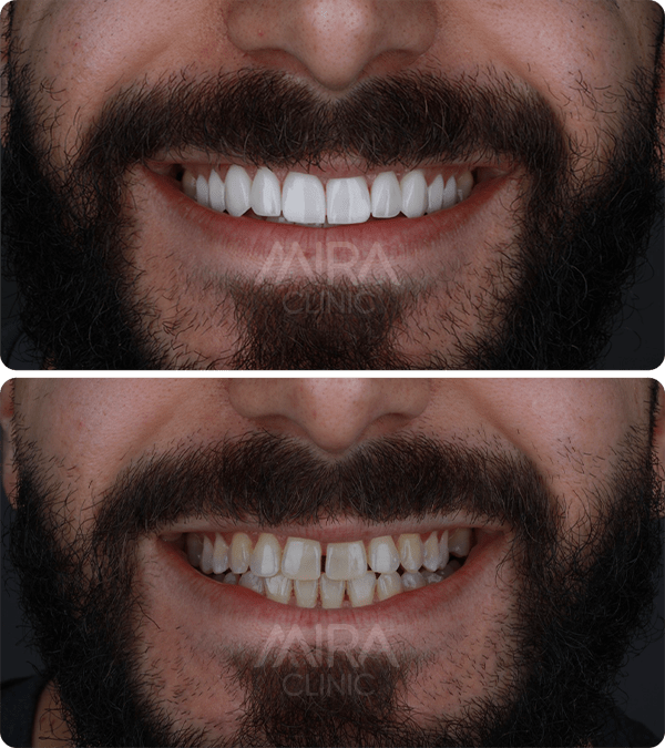 قبل و بعد عملية ابتسامة هوليود