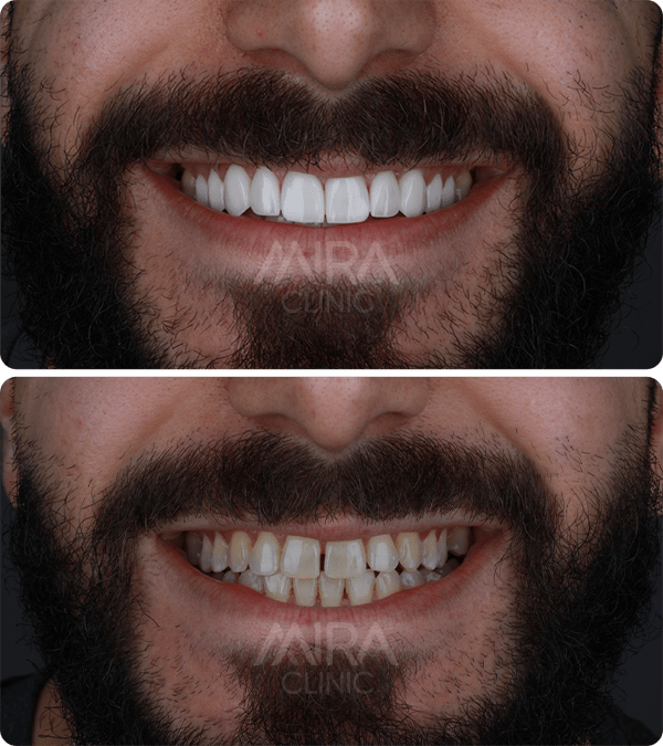 Before & After Hollywood smile 