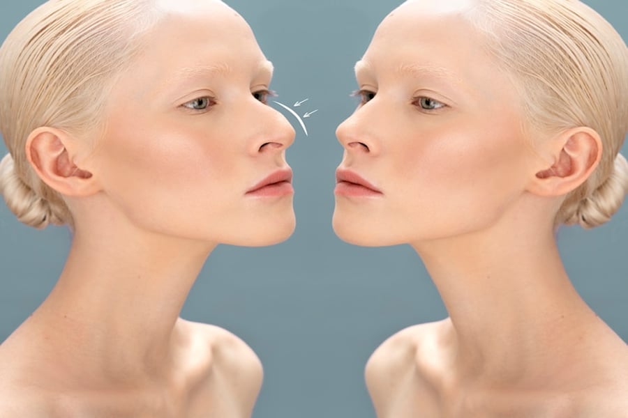 Rhinoplasty surgery