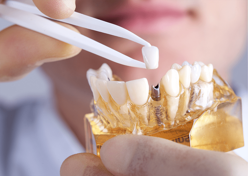 All-on-6 dental implant procedure in turkey 2023