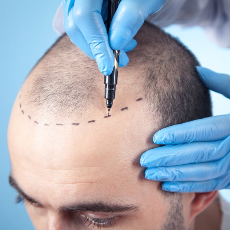 هل زراعة الشعر آمنة في تركيا؟