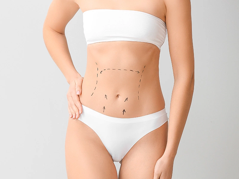 Une abdominoplastie vous aide-t-elle à perdre du poids ?