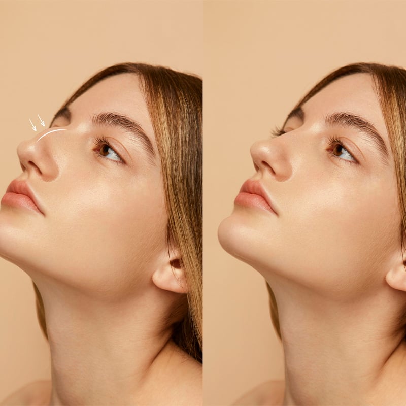 Rhinoplasty cost in Turkey