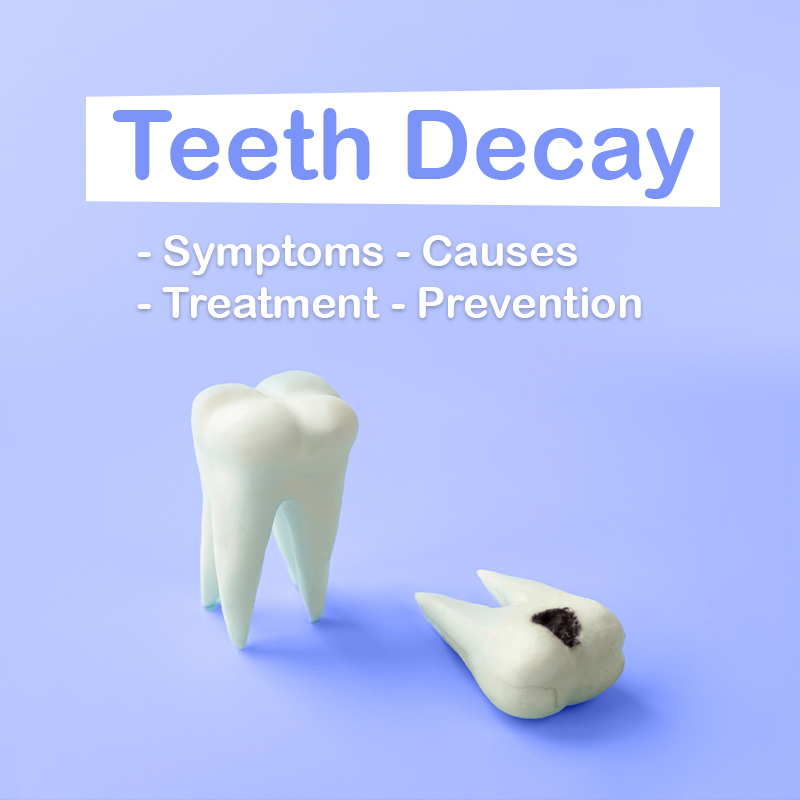 Tooth decay 