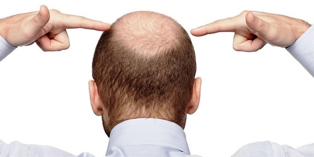 hair transplant cost