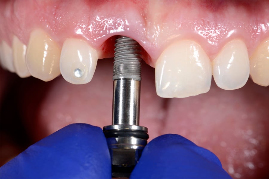  dental implant in turkey 2023