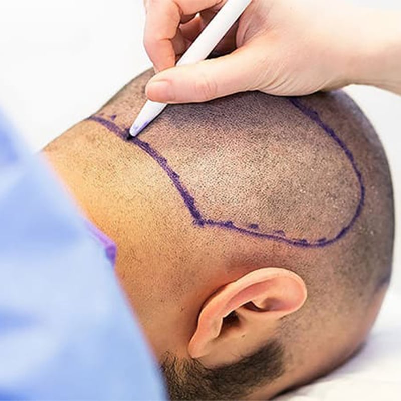  زراعة الشعر في تركيا