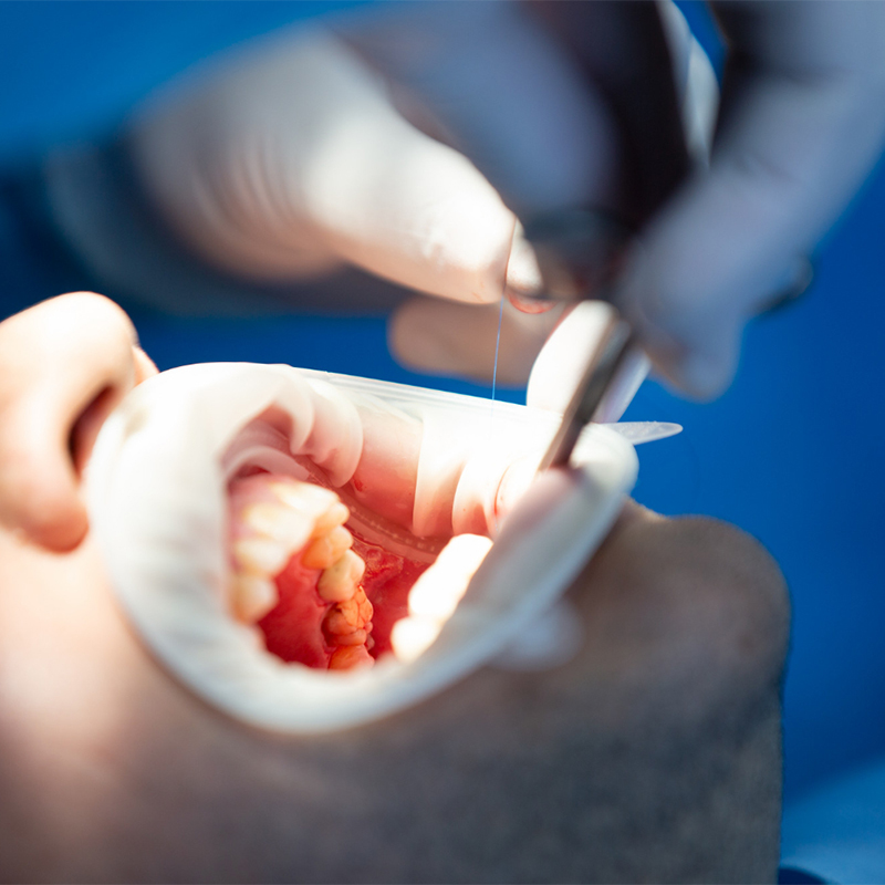 Coût de la procédure d’implant dentaire : Algérie vs Turquie