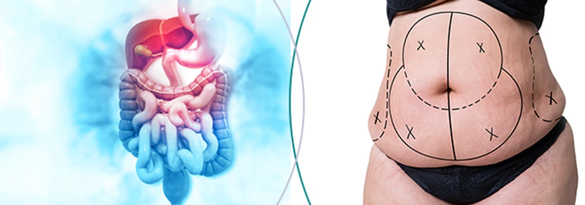 Coût de la chirurgie Bariatrique : USA vs UK vs France vs Turquie