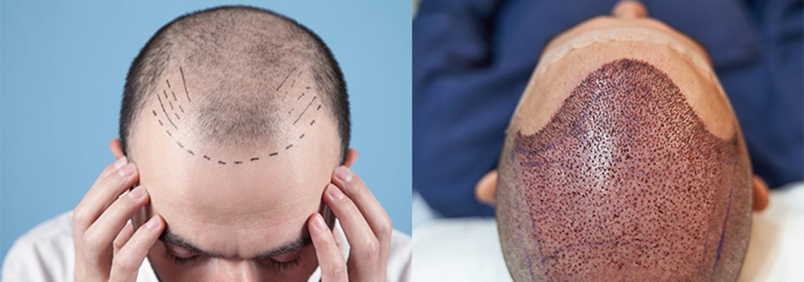 Everything you need to know about hair transplant in Turkey