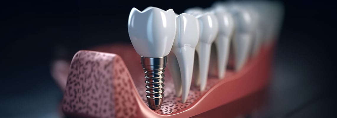 Best dental implant brands in the world: Detailed Guide