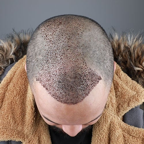 Greffe de cheveux en Turquie 2025 : techniques, récupération et coûts