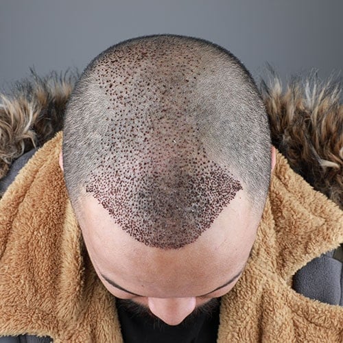 قبل و بعد عملية زراعة الشعر