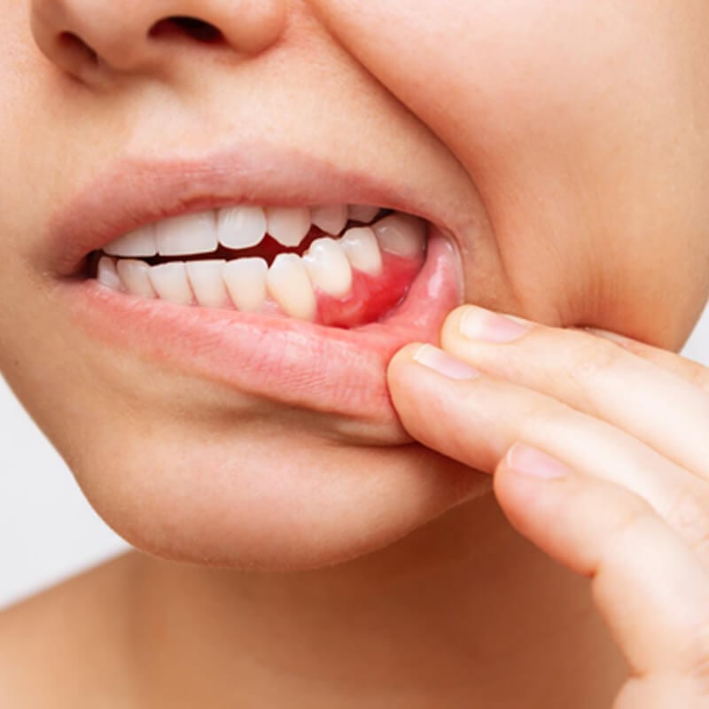 Gum infection: Symptoms, causes, treatment and prevention methods