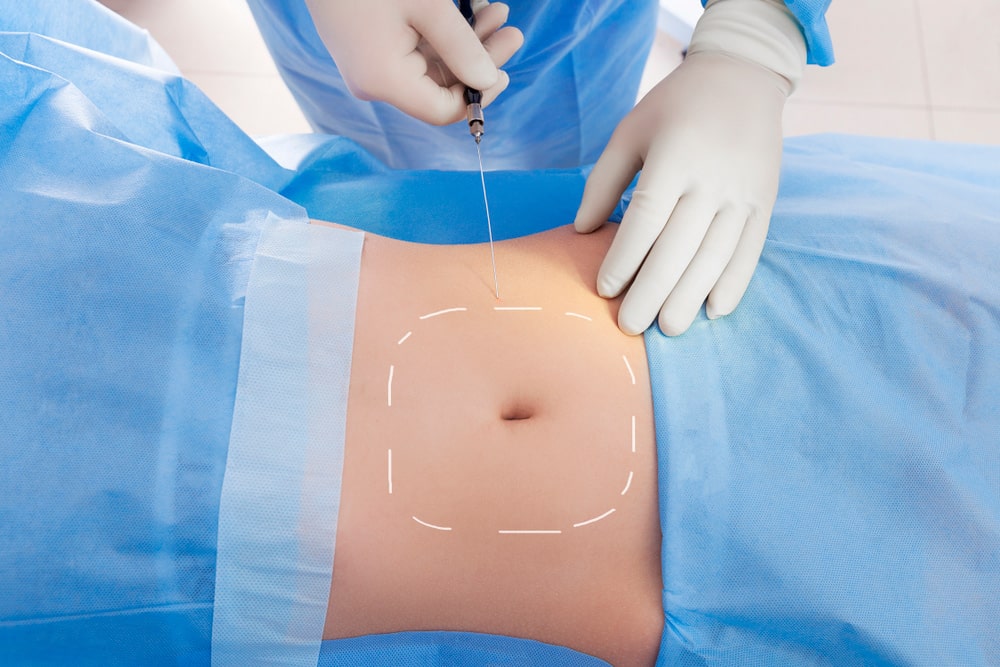What is the VASER liposuction technique? 