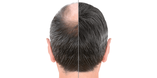 Hair transplantation for men in turkey 2023