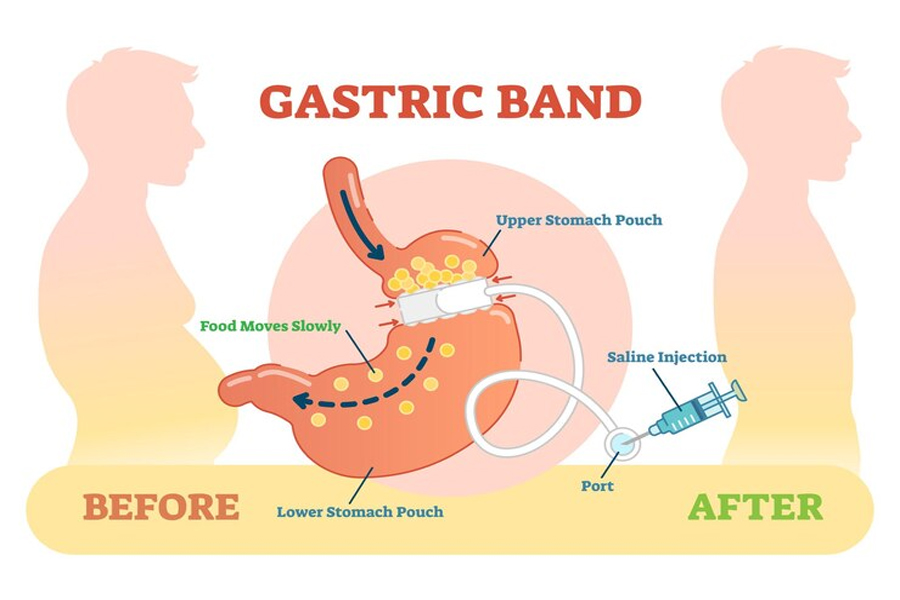 gastric banding