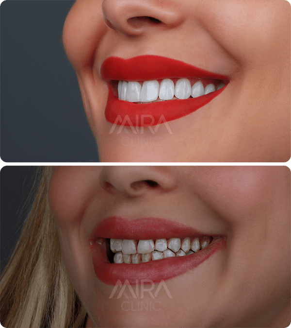 قبل و بعد عملية زراعة الأسنان 
