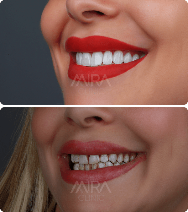 Before & After Dental Implant 