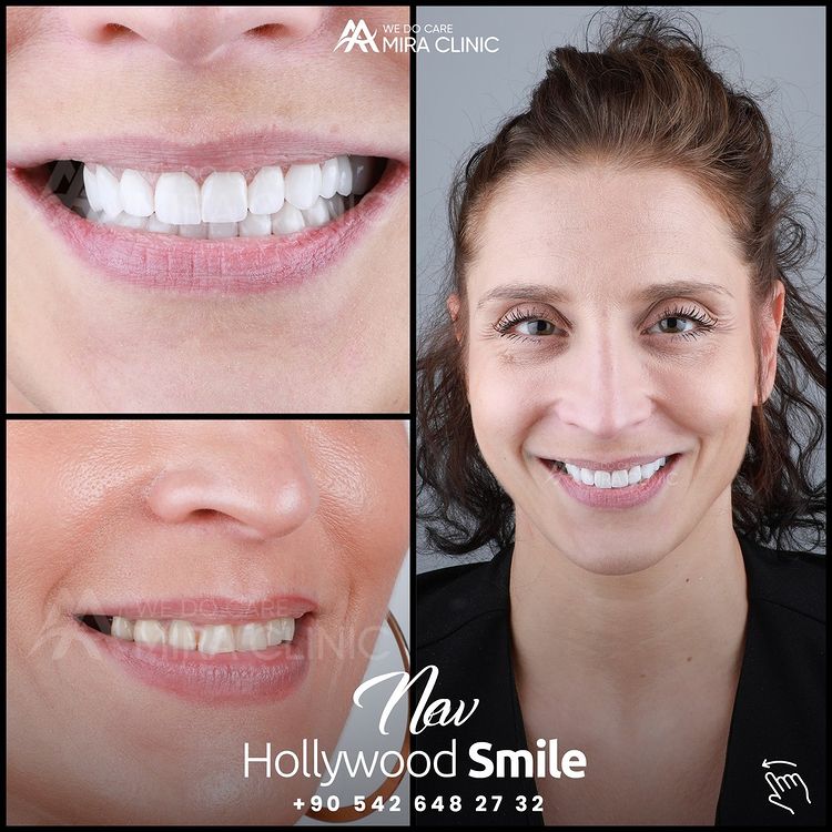 Hollywood Smile 2021 In Turkey