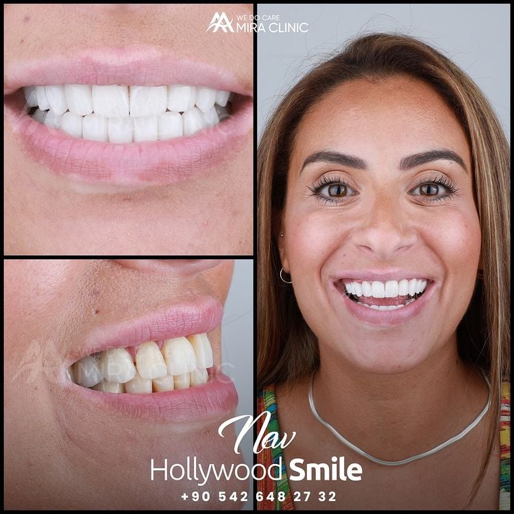 Hollywood Smile In Turkey
