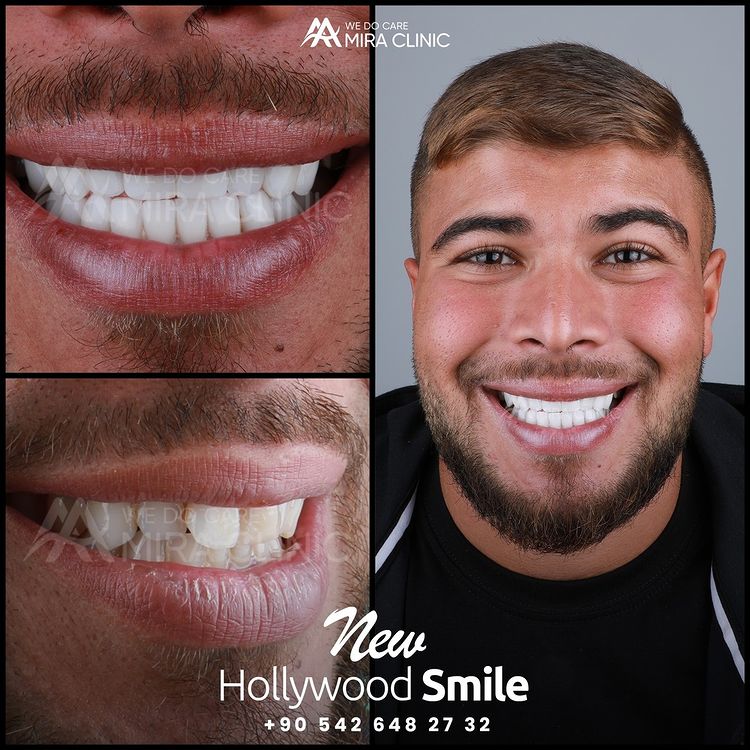 Hollywood Smile 