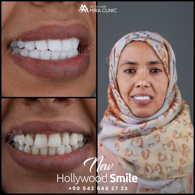 Hollywood Smile Istanbul
