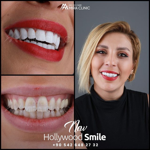 Hollywood smile procedure at Mira Clinic.