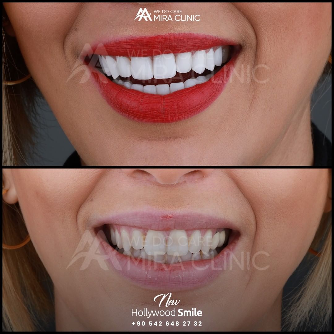 Hollywood Smile 2021 In Turkey