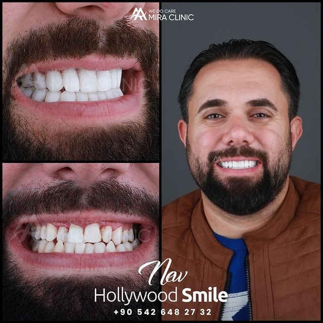 #hollywood_smile #hollywood #dental_implants #smile #miraclinic