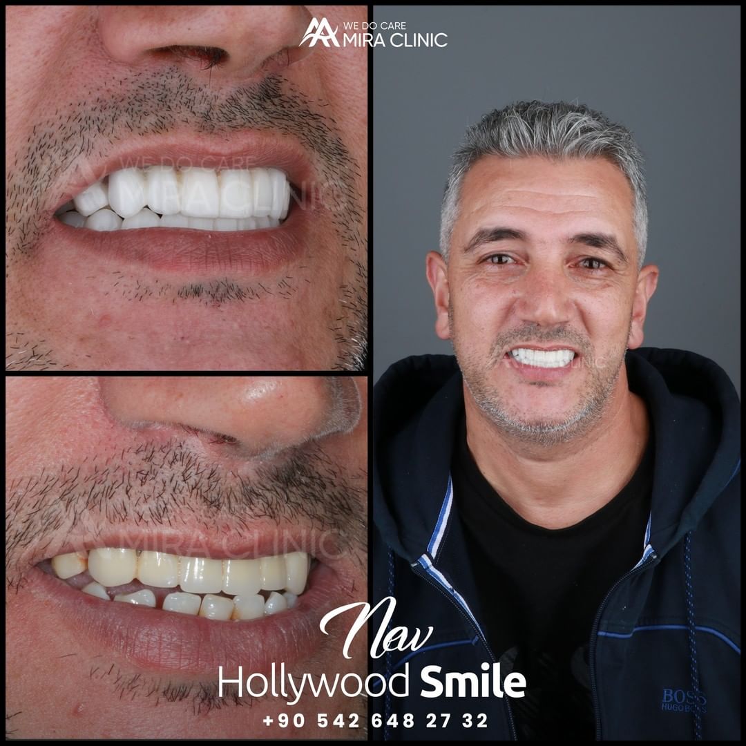 An astonishing new result of Hollywood Smile at Mira Clinic
