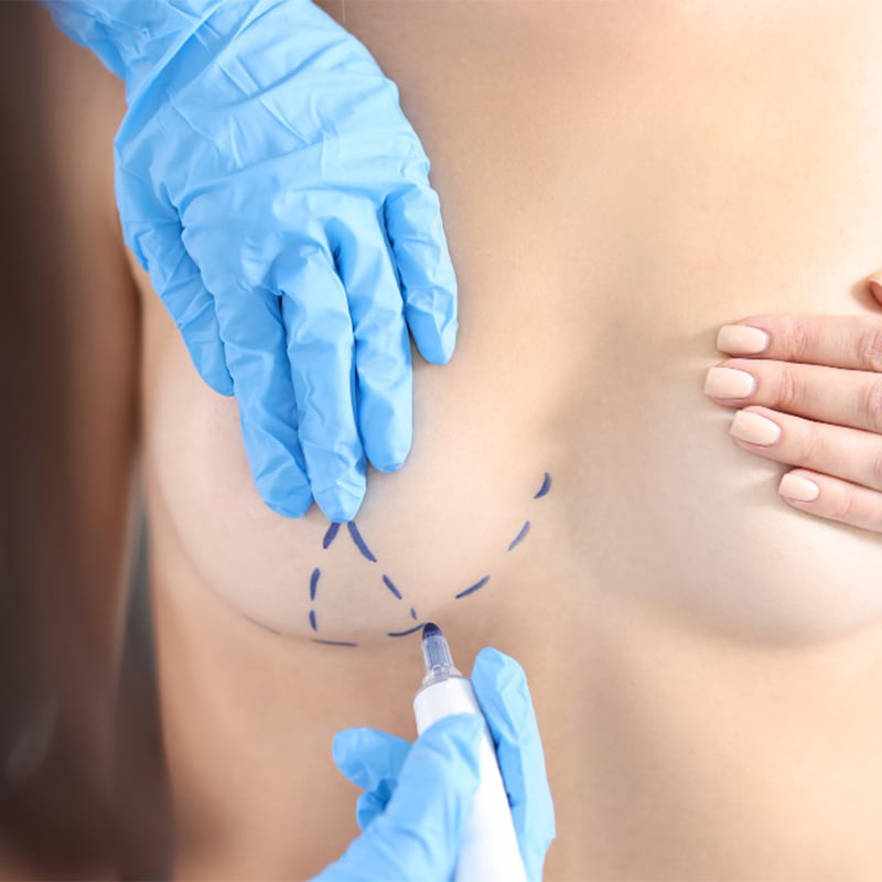 Breast augmentation with fat transfer in Turkey