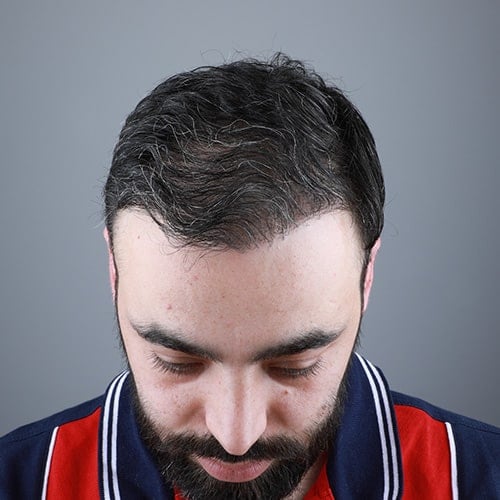قبل و بعد عملية زراعة الشعر عند الرجال