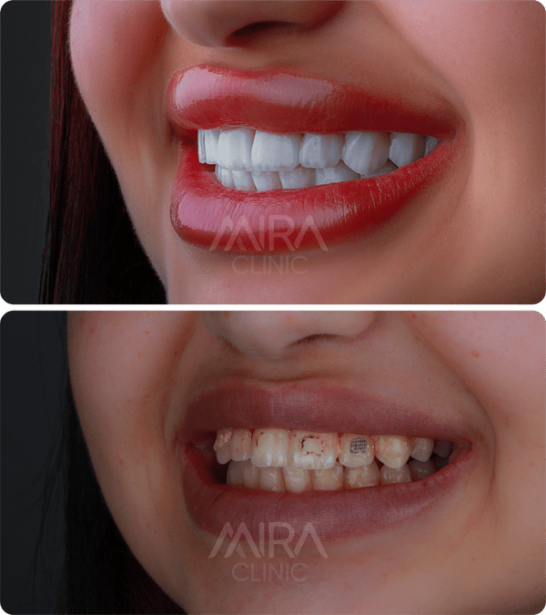 قبل و بعد عملية زراعة الأسنان