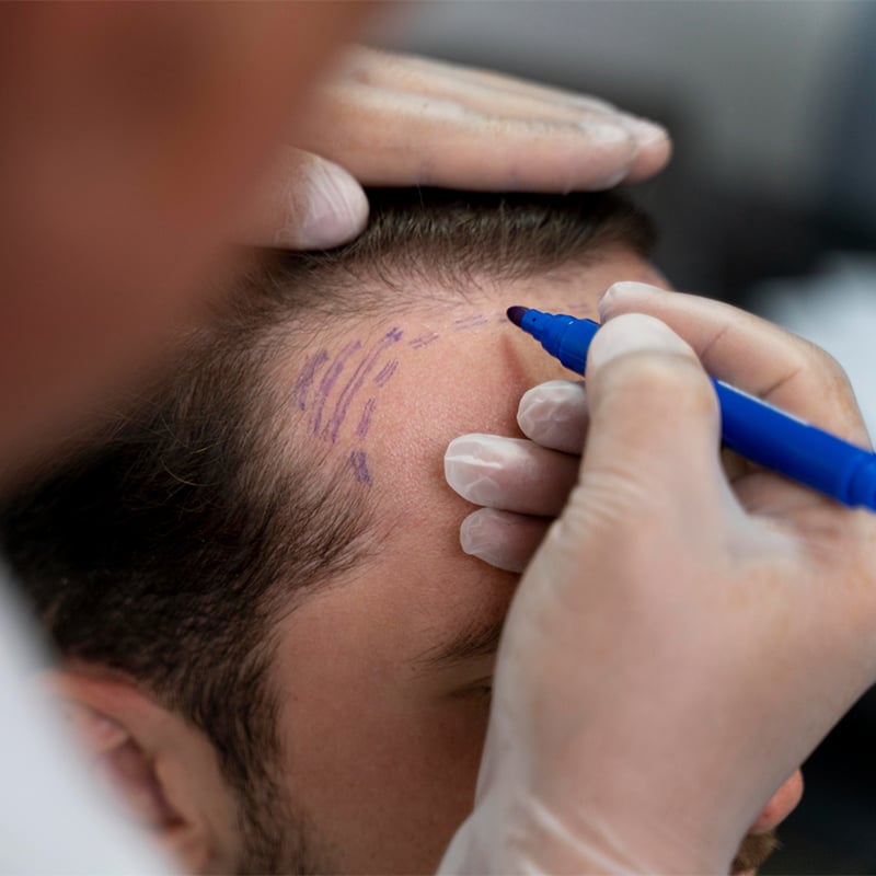 Les meilleures techniques de greffe de cheveux en Turquie