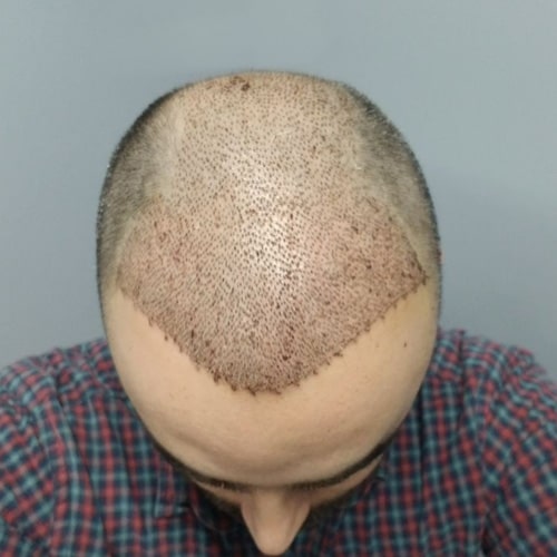 Before & After Hair transplantation for men 